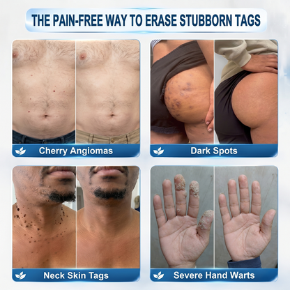 𝐇𝐈𝐒𝐊𝐈𝐍®👩‍⚕️ 𝟕-𝐃𝒂𝘆 𝐒𝗸𝐢𝐧 𝐓𝒂𝗴 & 𝐒𝐩𝙤𝐭 𝐄𝐫𝒂𝐬𝙚𝐫 Painless & Scar-Free Advanced Imper✨✨✨✨
