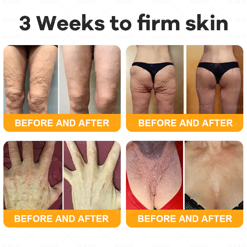 💥💥Made and Shipped from AU ✨ VLSVLS® Bee Venom Skin Restoration Cream 🌸 Anti-aging,Hydrating, Skin Repair, Even Tone, Acne and Dark Spot Treatment, Wart and Mole Removal, Psoriasis Relief 🔥 LAST DAY 80% OFF 💎