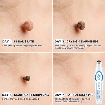 𝐇𝐈𝐒𝐊𝐈𝐍®👩‍⚕️ 𝟕-𝐃𝒂𝘆 𝐒𝗸𝐢𝐧 𝐓𝒂𝗴 & 𝐒𝐩𝙤𝐭 𝐄𝐫𝒂𝐬𝙚𝐫 Painless & Scar-Free Advanced Imper✨✨✨✨